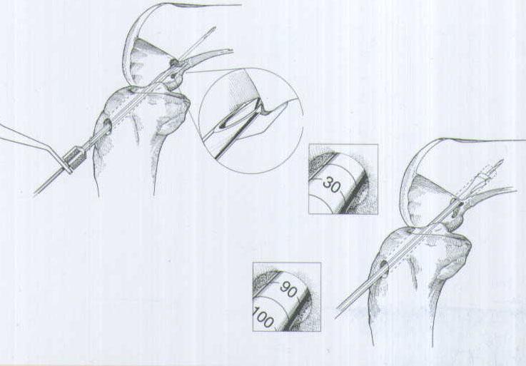 肌腱韌帶固定系統(tǒng)注冊技術(shù)審查指導原則（2020年第36號）(圖1)